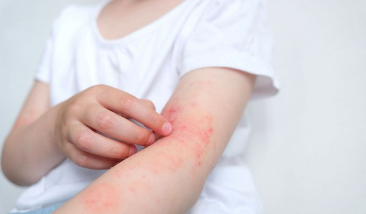 Fasciíte necrosante: infecção bacteriana rara pode ser fatal